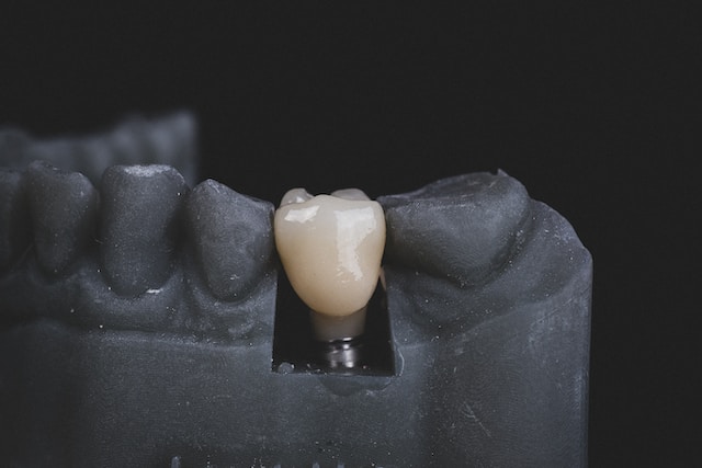 Why consider dental implants?